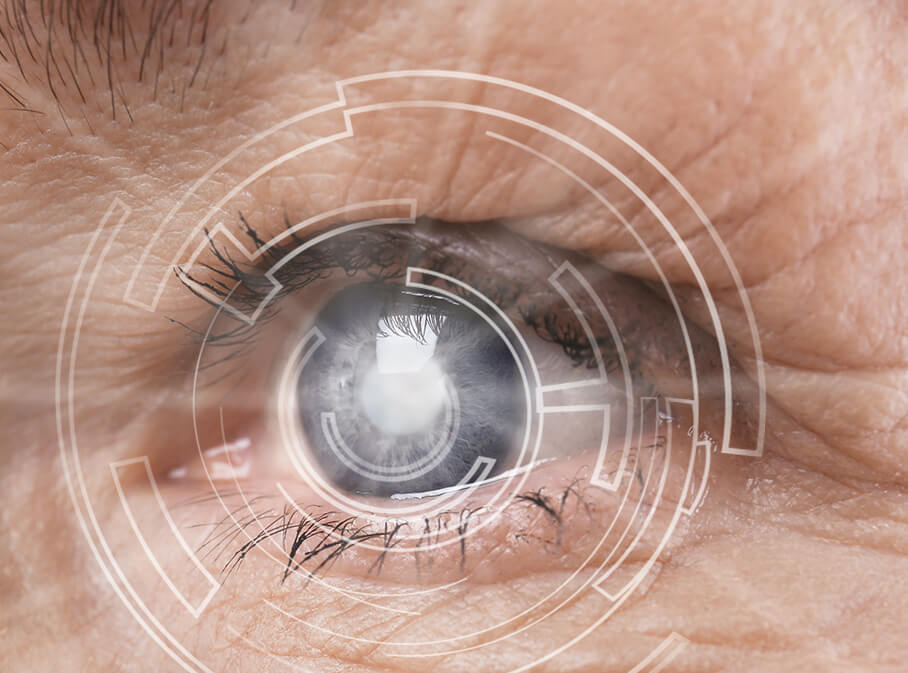 Grauer Star Op im Augenlaserzentrum Neu-Ulm Grauer Star Op im Augenlaserzentrum Neu-Ulm