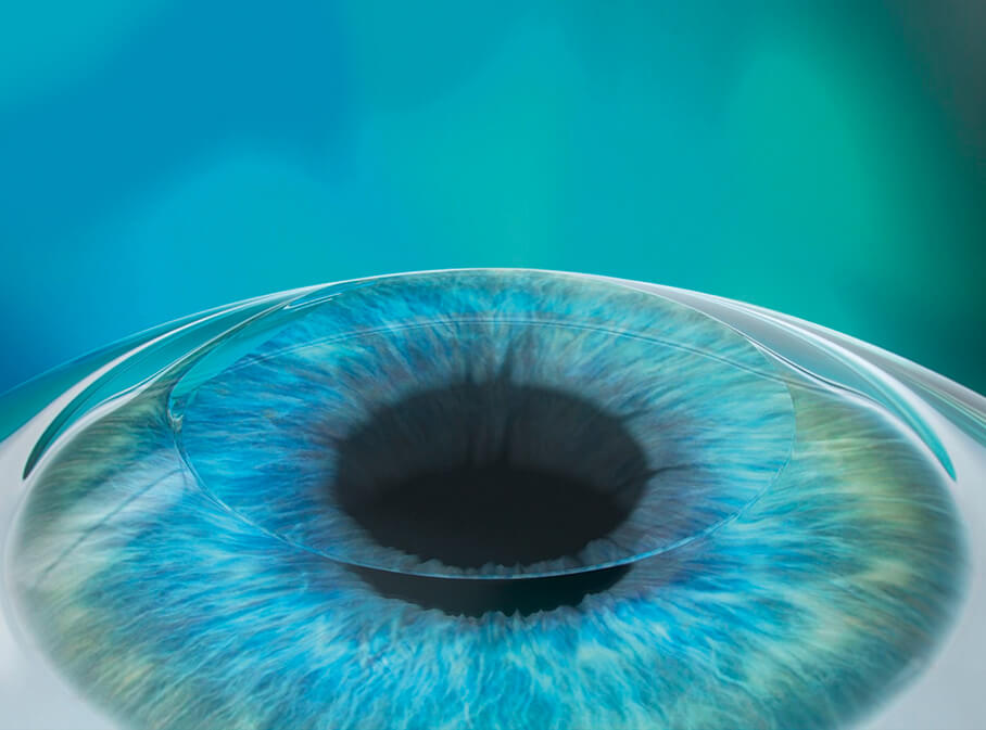 Step 4: Korrektur Ihrer Fehlsichtigkeit mittels Femto-Lasik Step 4: Korrektur Ihrer Fehlsichtigkeit mittels Femto-Lasik